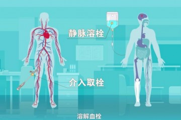 溶栓治療有風險嗎一般多少錢？溶栓對身體傷害有多大？血栓是怎么形成的